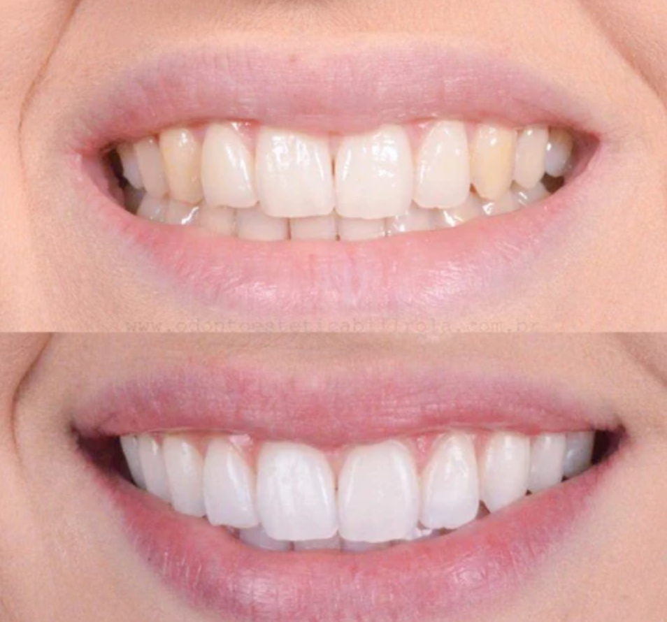 Teeth whitening pen – Clinically inspired whitening at home