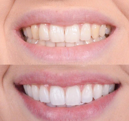 Teeth whitening pen – Clinically inspired whitening at home